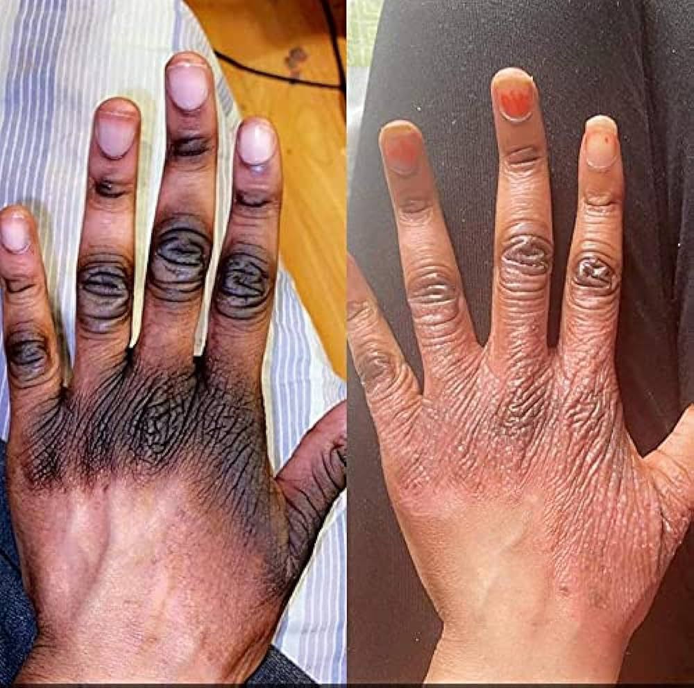 Solution Anti Quinto, Tâches et Boutons Après Rasage - Peau Parfaite en 7 Jours