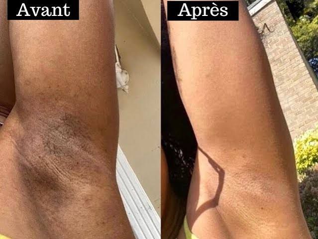 Solution Anti Quinto, Tâches et Boutons Après Rasage - Peau Parfaite en 7 Jours