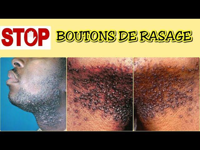 Solution Anti Quinto, Tâches et Boutons Après Rasage - Peau Parfaite en 7 Jours