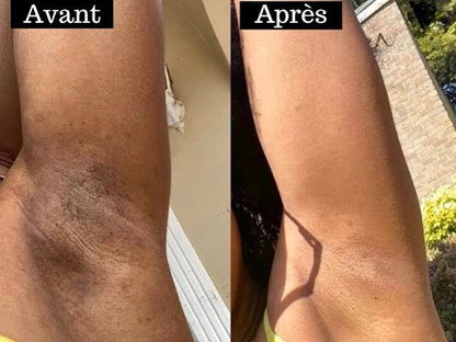 Solution Anti Quinto, Tâches et Boutons Après Rasage - Peau Parfaite en 7 Jours