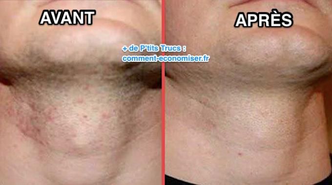 Solution Anti Quinto, Tâches et Boutons Après Rasage - Peau Parfaite en 7 Jours