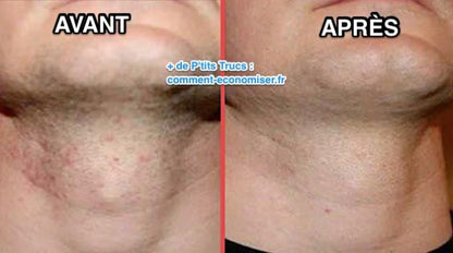 Solution Anti Quinto, Tâches et Boutons Après Rasage - Peau Parfaite en 7 Jours